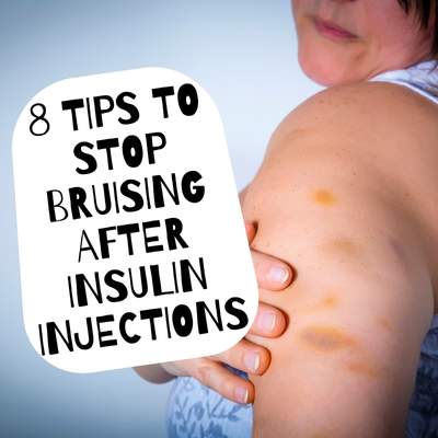 Fear of needles? 8 Tips to stop bruising after insulin injections